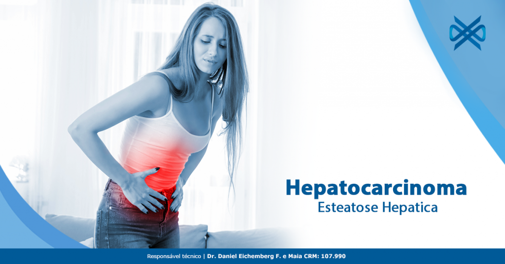 Hepatocarcinoma: esteatose hepática